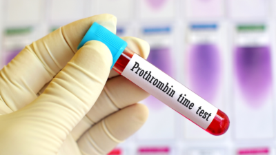 ¿Qué hacer cuando el tiempo de protrombina es alto?