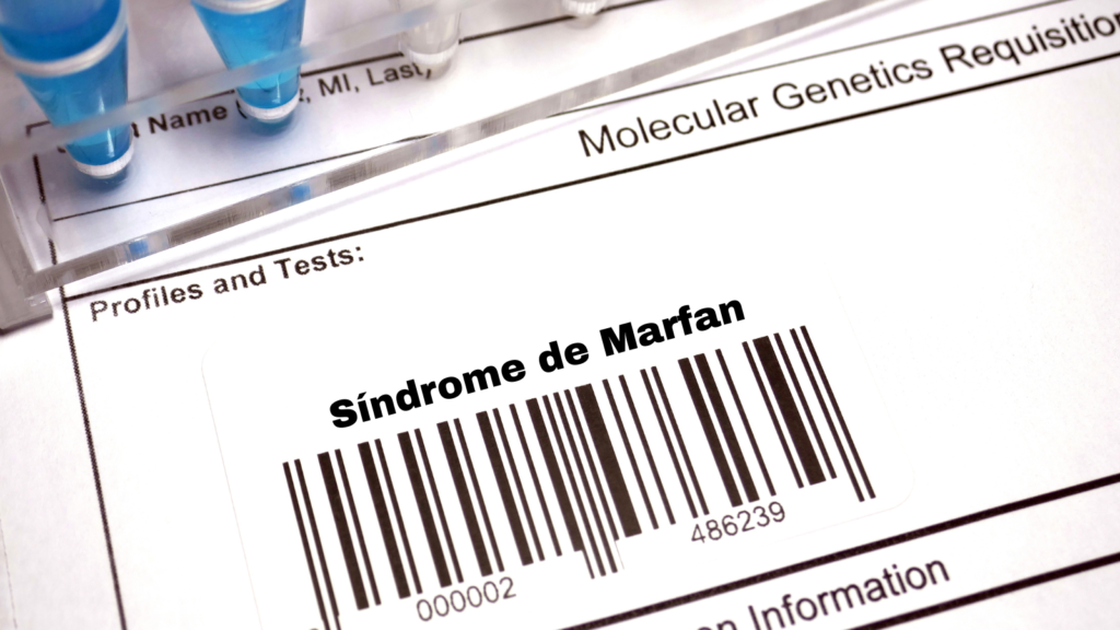 Causas del Síndrome de Marfan