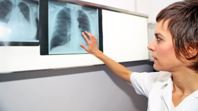 Trombo pulmonar: enfermedad, síntomas y tratamientos